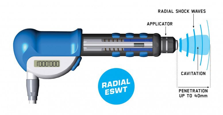 Radial Shock Wave Therapy Handpiece Radial Shock Wave Therapy Handpiece